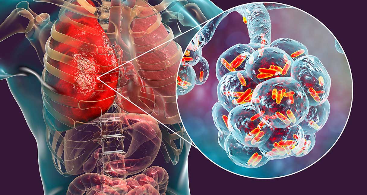 Legionarries disease